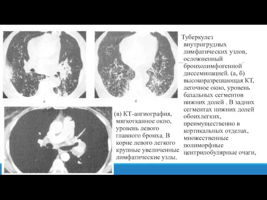 Туберкулез внутригрудных лимфатических узлов, осложненный бронхолимфогенной диссеминацией. (а, б) высокоразрешающая КТ, легочное