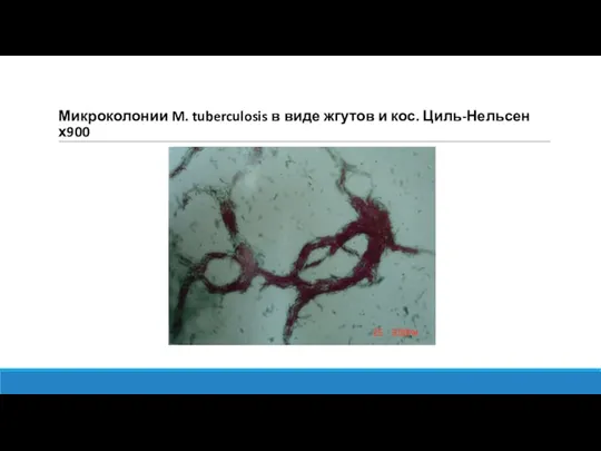 Микроколонии M. tuberculosis в виде жгутов и кос. Циль-Нельсен х900