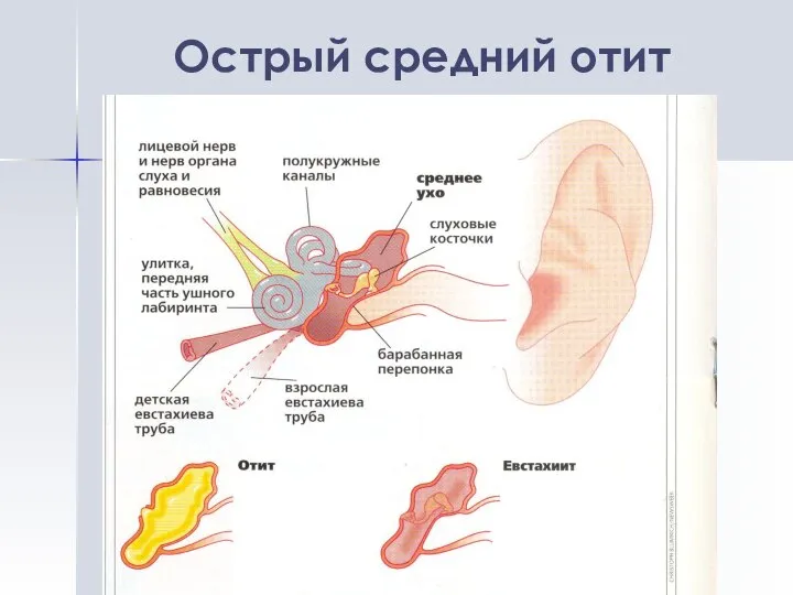 Острый средний отит