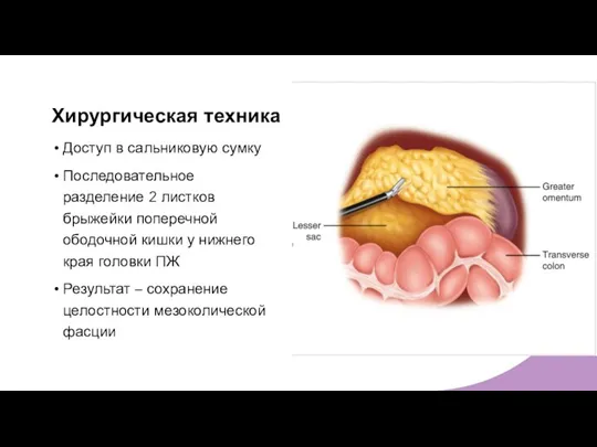 Хирургическая техника Доступ в сальниковую сумку Последовательное разделение 2 листков брыжейки поперечной