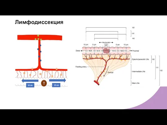 Лимфодиссекция