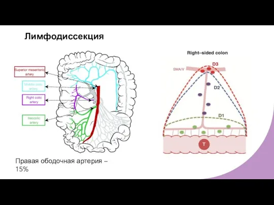 Лимфодиссекция Правая ободочная артерия – 15%