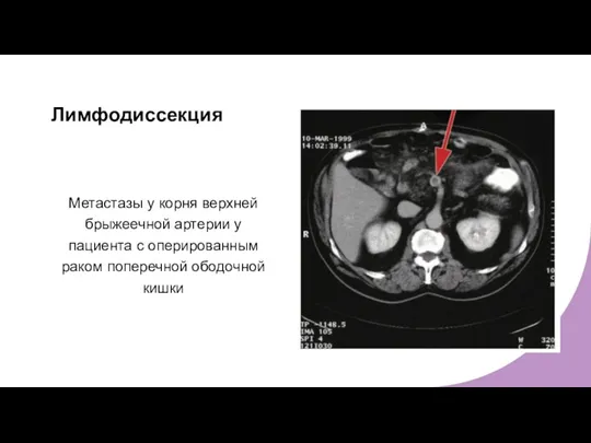 Лимфодиссекция Метастазы у корня верхней брыжеечной артерии у пациента с оперированным раком поперечной ободочной кишки