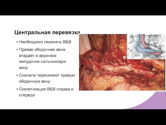 Центральная перевязка Необходимо пересечь ВБВ Правая ободочная вена впадает в верхнюю желудочно-сальниковую