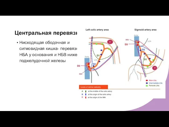 Центральная перевязка Нисходящая ободочная и сигмовидная кишка- перевязка НБА у основания и НБВ ниже поджелудочной железы