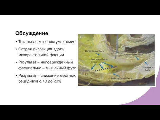 Обсуждение Тотальная мезоректумэктомия Острая диссекция вдоль мезоректальной фасции Результат – неповрежденный фасциально