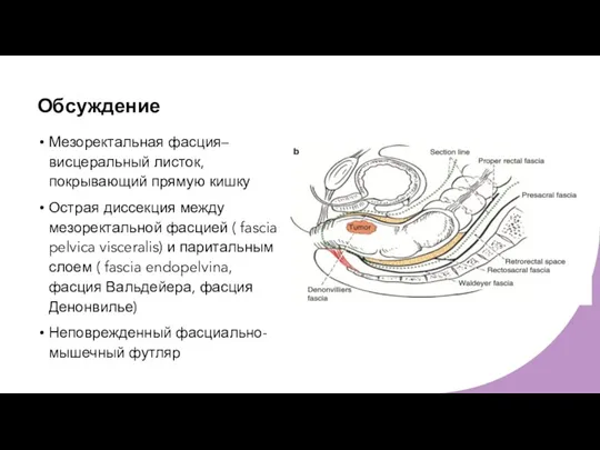 Обсуждение Мезоректальная фасция– висцеральный листок, покрывающий прямую кишку Острая диссекция между мезоректальной