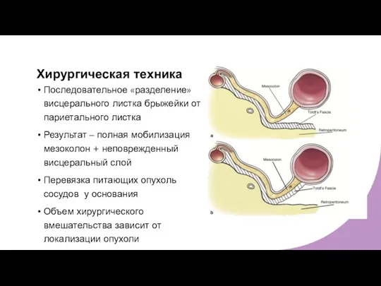 Хирургическая техника Последовательное «разделение» висцерального листка брыжейки от париетального листка Результат –