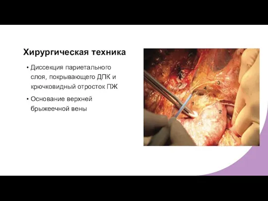 Хирургическая техника Диссекция париетального слоя, покрывающего ДПК и крючковидный отросток ПЖ Основание верхней брыжеечной вены