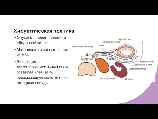 Хирургическая техника Опухоль – левая половина ободочной кишки Мобилизация селезеночного изгиба Диссекция