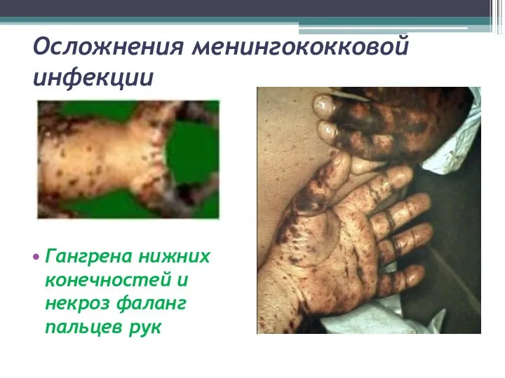 Осложнения менингококковой инфекции Гангрена нижних конечностей и некроз фаланг пальцев рук