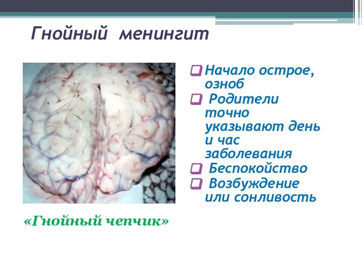 Гнойный менингит Начало острое, озноб Родители точно указывают день и час заболевания