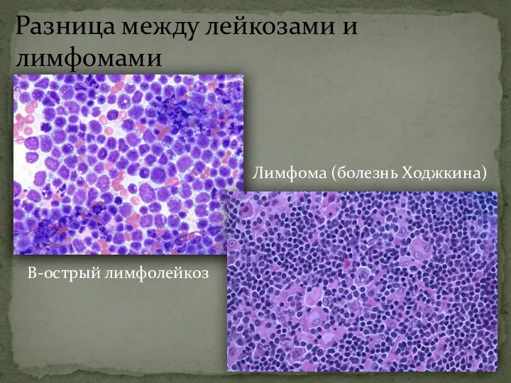 Разница между лейкозами и лимфомами В-острый лимфолейкоз Лимфома (болезнь Ходжкина)