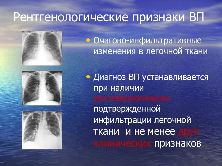 Рентгенологические признаки ВП Очагово-инфильтративные изменения в легочной ткани Диагноз ВП устанавливается при