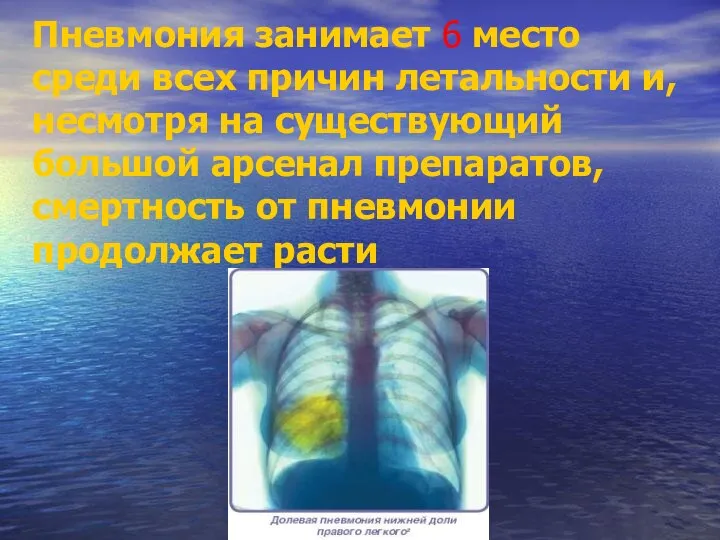 Пневмония занимает 6 место среди всех причин летальности и, несмотря на существующий