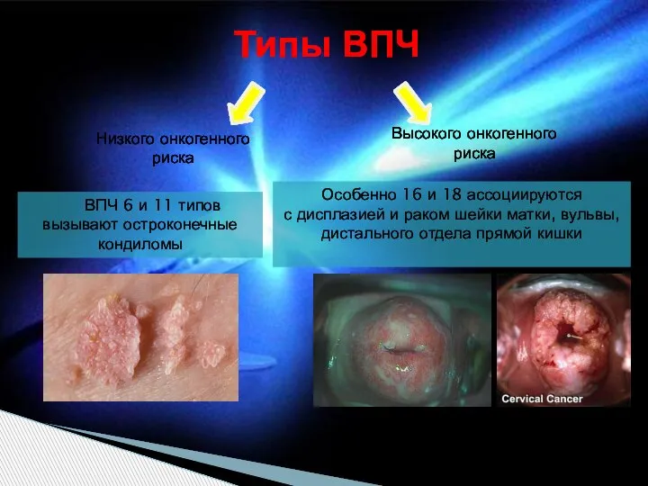 Типы ВПЧ Низкого онкогенного риска Высокого онкогенного риска ВПЧ 6 и 11