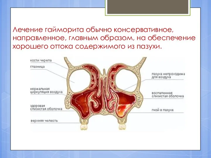 Лечение гайморита обычно консервативное, направленное, главным образом, на обеспечение хорошего оттока содержимого из пазухи.