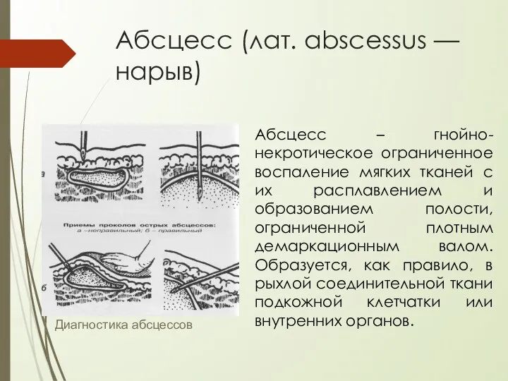 Абсцесс (лат. abscessus — нарыв) Диагностика абсцессов Абсцесс – гнойно-некротическое ограниченное воспаление