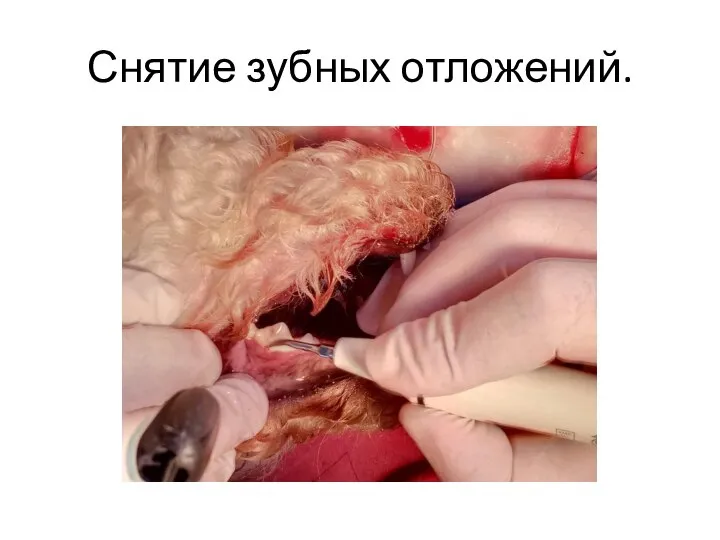 Снятие зубных отложений.