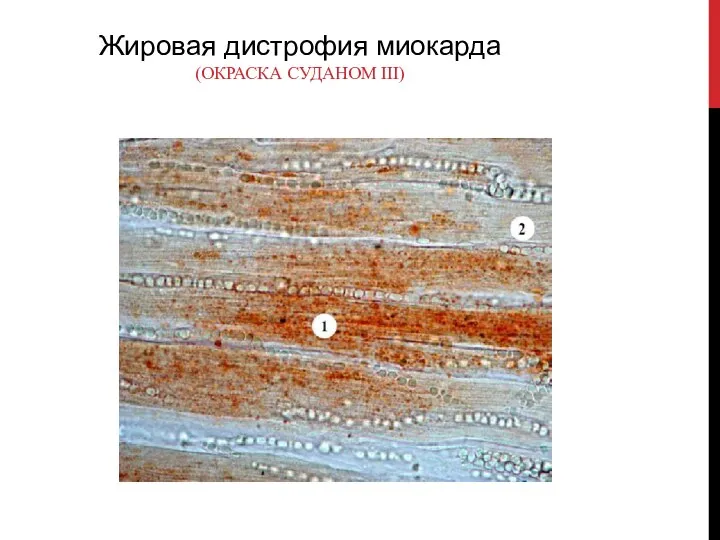 Жировая дистрофия миокарда (ОКРАСКА СУДАНОМ III)