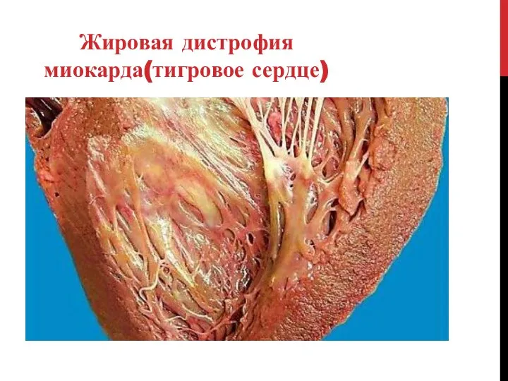 Жировая дистрофия миокарда(тигровое сердце)