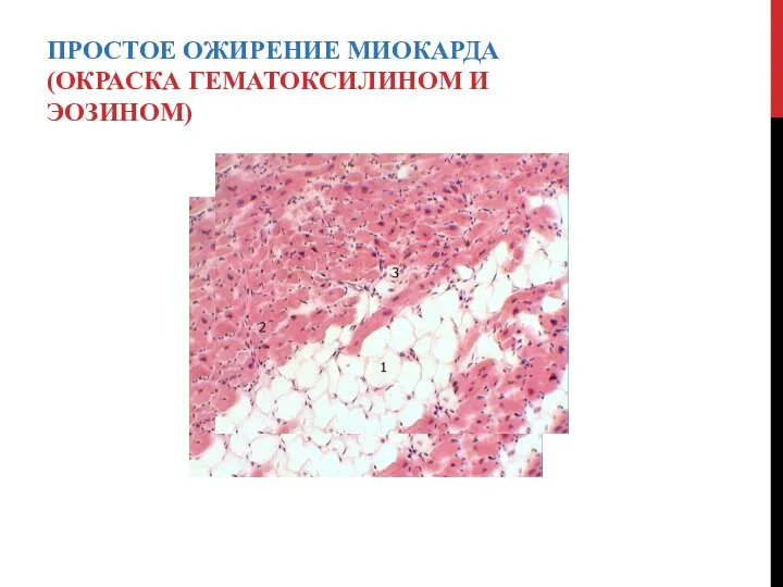 ПРОСТОЕ ОЖИРЕНИЕ МИОКАРДА(ОКРАСКА ГЕМАТОКСИЛИНОМ И ЭОЗИНОМ)