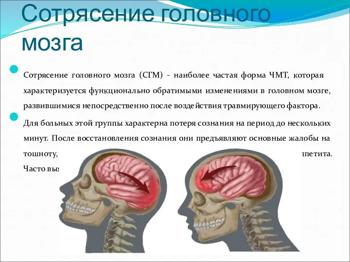 Сотрясение головного мозга Сотрясение головного мозга (СГМ) - наиболее частая форма ЧМТ,