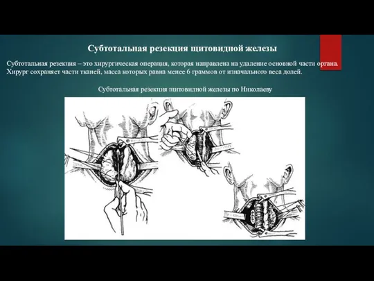 Субтотальная резекция щитовидной железы Субтотальная резекция – это хирургическая операция, которая направлена