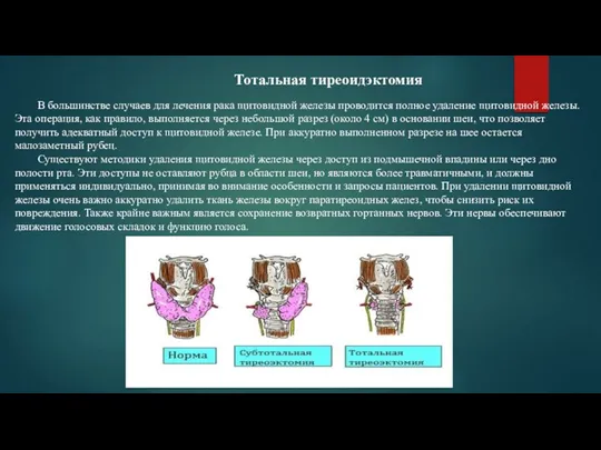 Тотальная тиреоидэктомия В большинстве случаев для лечения рака щитовидной железы проводится полное