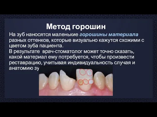 Метод горошин На зуб наносятся маленькие горошины материала разных оттенков, которые визуально