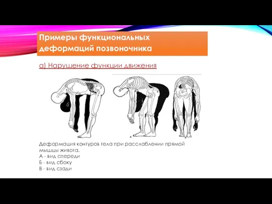 Деформация контуров тела при расслаблении прямой мышцы живота. А - вид спереди