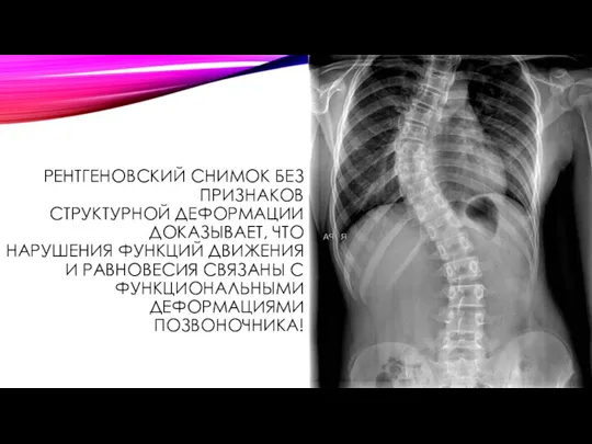 РЕНТГЕНОВСКИЙ СНИМОК БЕЗ ПРИЗНАКОВ СТРУКТУРНОЙ ДЕФОРМАЦИИ ДОКАЗЫВАЕТ, ЧТО НАРУШЕНИЯ ФУНКЦИЙ ДВИЖЕНИЯ И