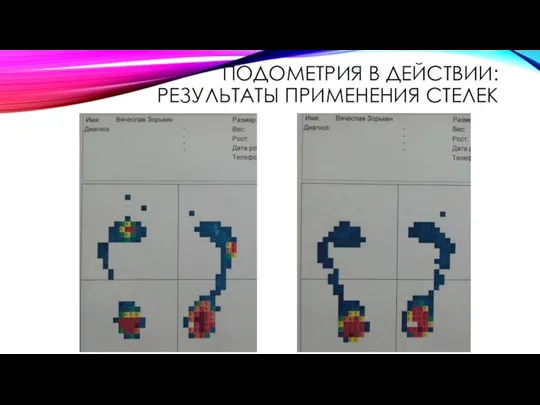 ПОДОМЕТРИЯ В ДЕЙСТВИИ: РЕЗУЛЬТАТЫ ПРИМЕНЕНИЯ СТЕЛЕК