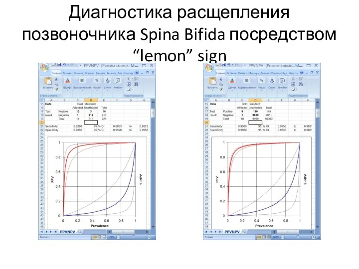 Диагностика расщепления позвоночника Spina Bifida посредством “lemon” sign