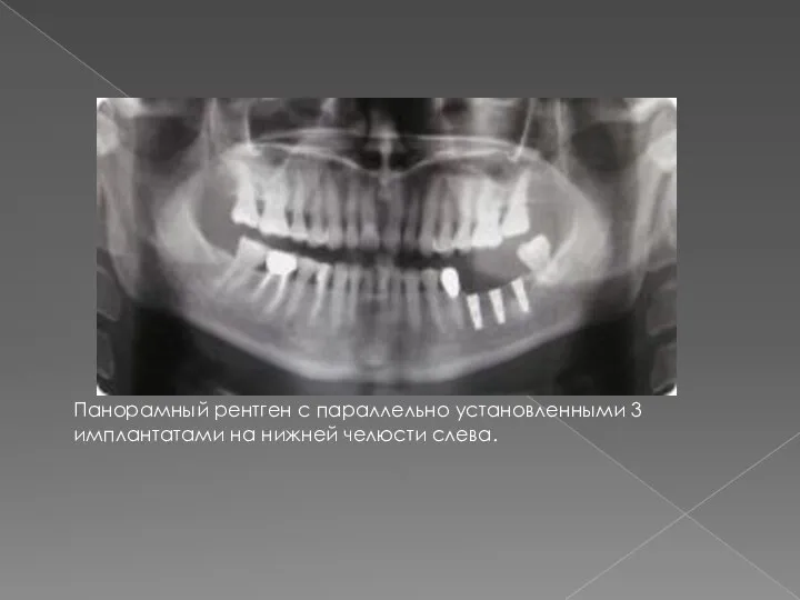 Панорамный рентген с параллельно установленными 3 имплантатами на нижней челюсти слева.