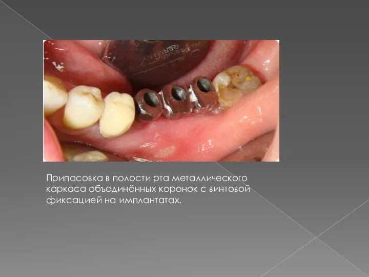 Припасовка в полости рта металлического каркаса объединённых коронок с винтовой фиксацией на имплантатах.