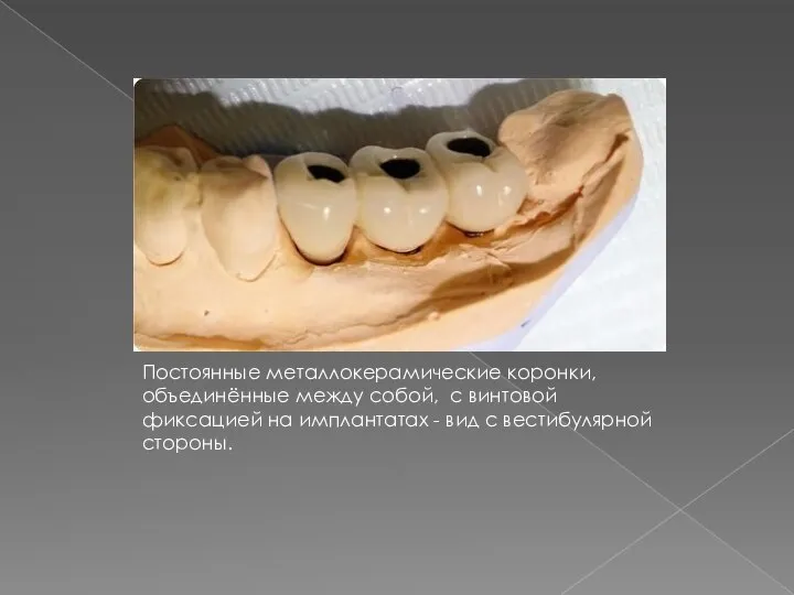 Постоянные металлокерамические коронки, объединённые между собой, с винтовой фиксацией на имплантатах - вид с вестибулярной стороны.