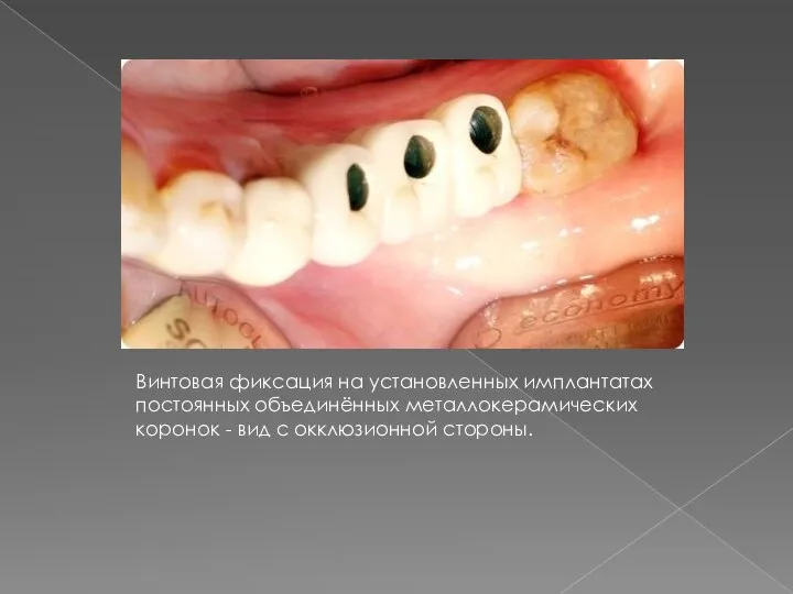 Винтовая фиксация на установленных имплантатах постоянных объединённых металлокерамических коронок - вид с окклюзионной стороны.