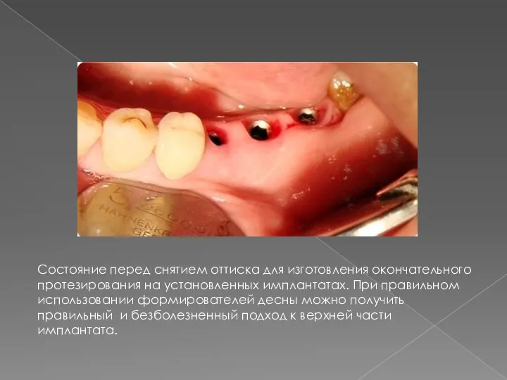 Состояние перед снятием оттиска для изготовления окончательного протезирования на установленных имплантатах. При