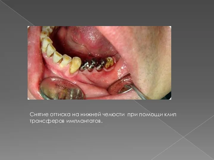 Снятие оттиска на нижней челюсти при помощи клип трансферов имплантатов.