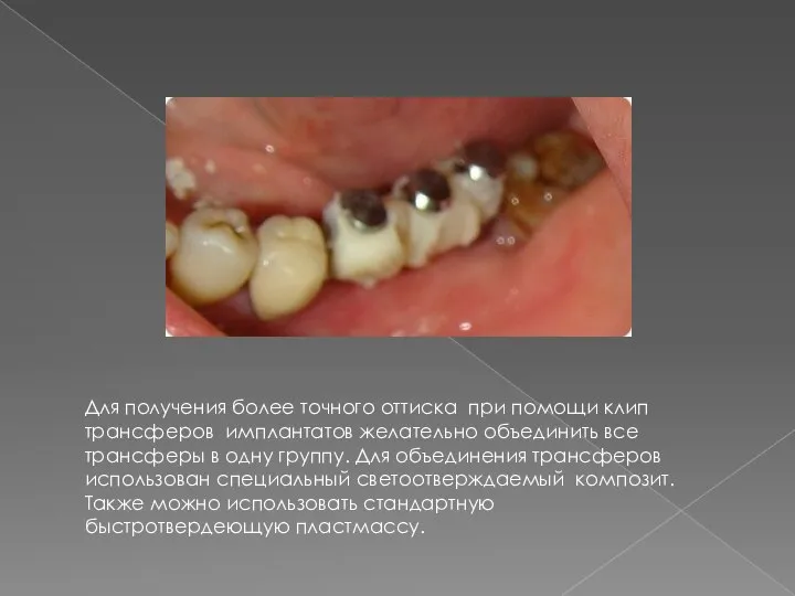 Для получения более точного оттиска при помощи клип трансферов имплантатов желательно объединить