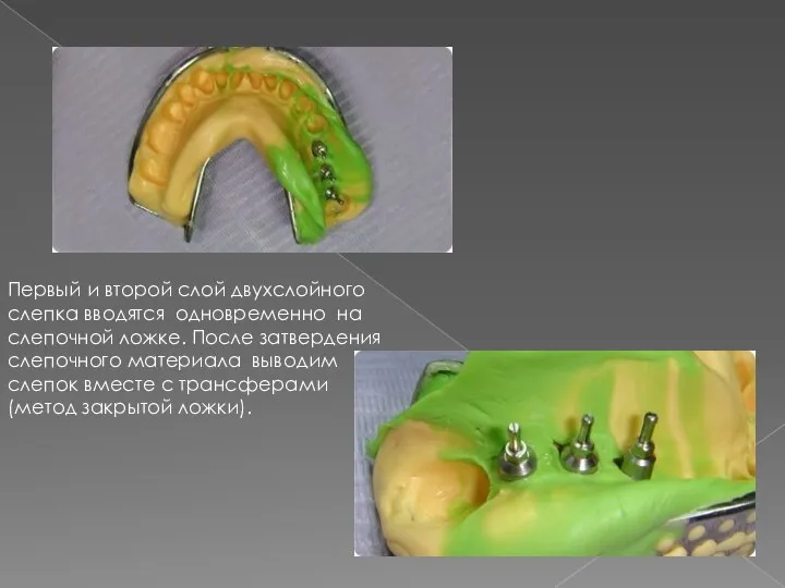 Первый и второй слой двухслойного слепка вводятся одновременно на слепочной ложке. После