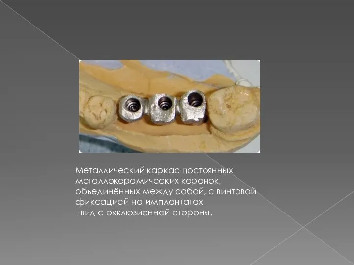 Металлический каркас постоянных металлокерамических коронок, объединённых между собой, с винтовой фиксацией на