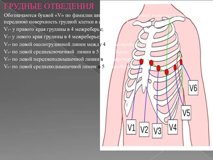 ГРУДНЫЕ ОТВЕДЕНИЯ Обозначаются буквой «V» по фамилии автора Vilson. Активный электрод помещается