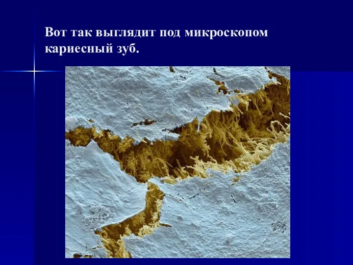 Вот так выглядит под микроскопом кариесный зуб.