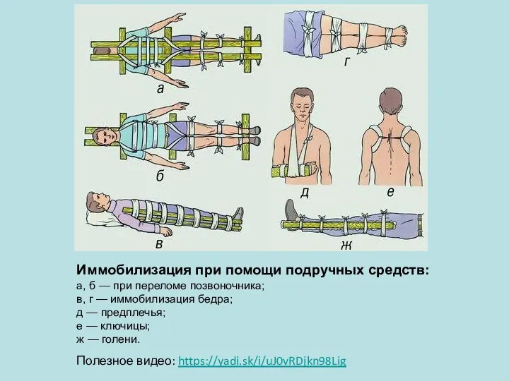 Иммобилизация при помощи подручных средств: а, б — при переломе позвоночника; в,