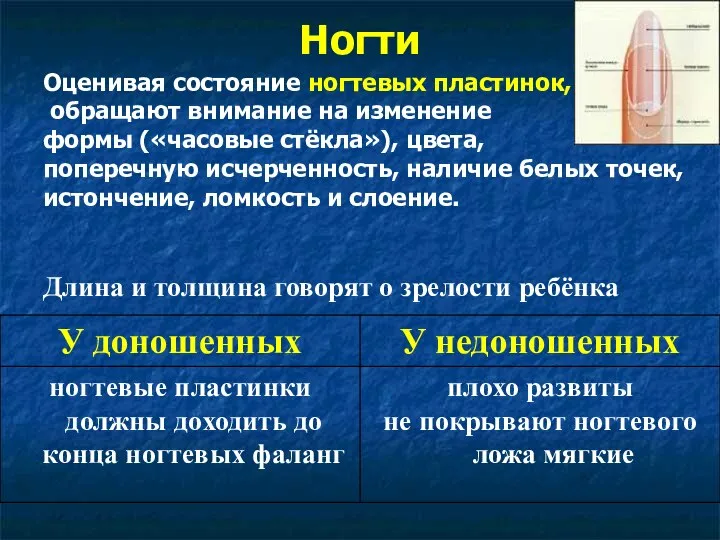 Ногти Оценивая состояние ногтевых пластинок, обращают внимание на изменение формы («часовые стёкла»),