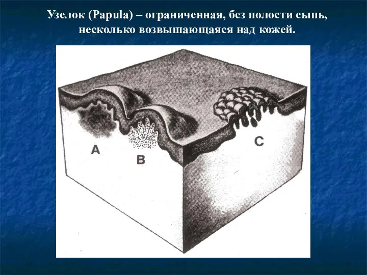 Узелок (Papula) – ограниченная, без полости сыпь, несколько возвышающаяся над кожей.