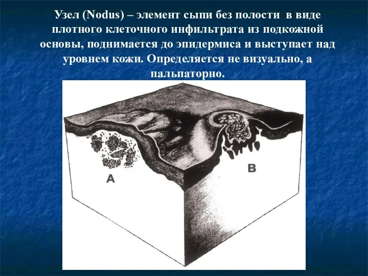 Узел (Nodus) – элемент сыпи без полости в виде плотного клеточного инфильтрата