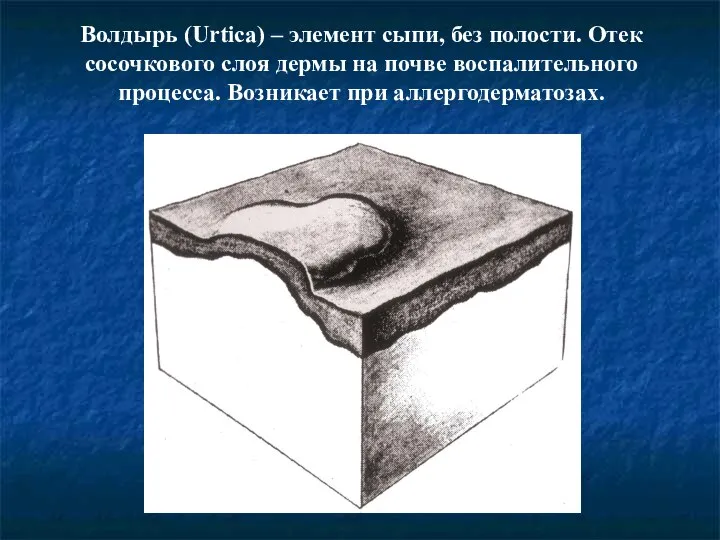 Волдырь (Urtica) – элемент сыпи, без полости. Отек сосочкового слоя дермы на